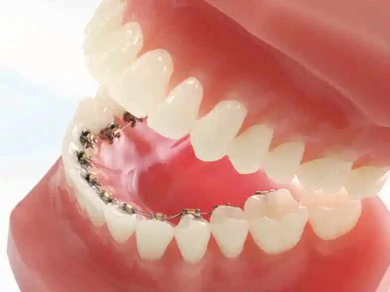 裏側ワイヤー矯正